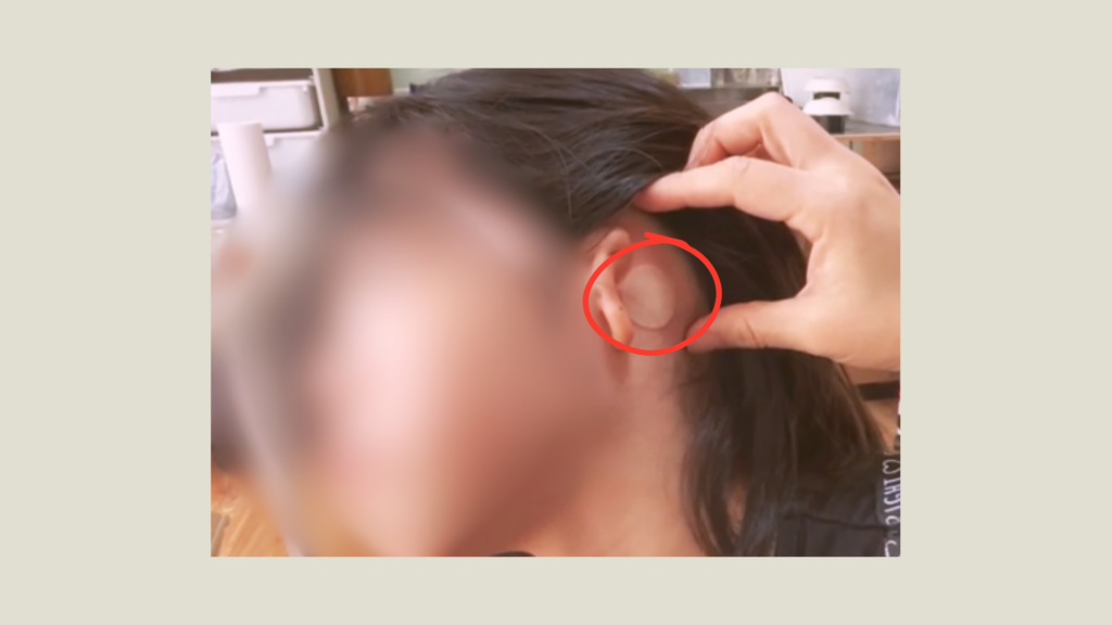 エピテーゼのパッチテストの様子。耳の後ろの肌でテスト